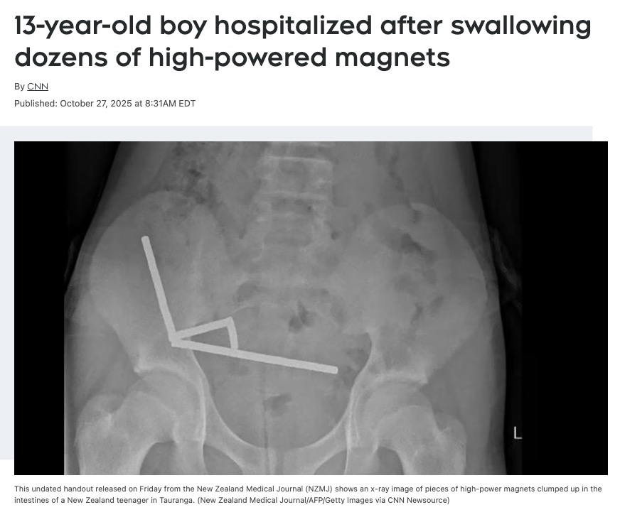 🇳🇿 新西兰13岁男孩吞下数十颗强力磁铁，导致部分肠道被切除